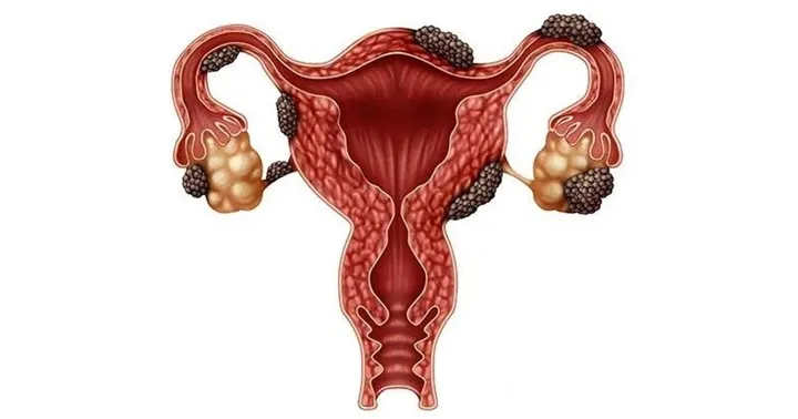 endometrio